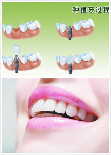 镶牙和种植牙之间的区别有哪些呢