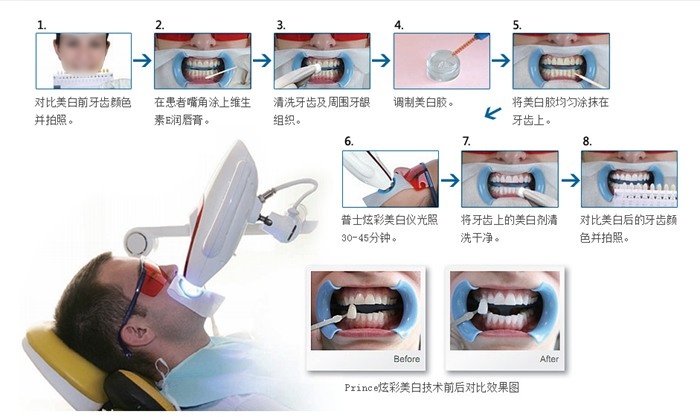 徐州强华BEYOND冷光美白治疗过程