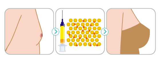 自体脂肪隆胸流程