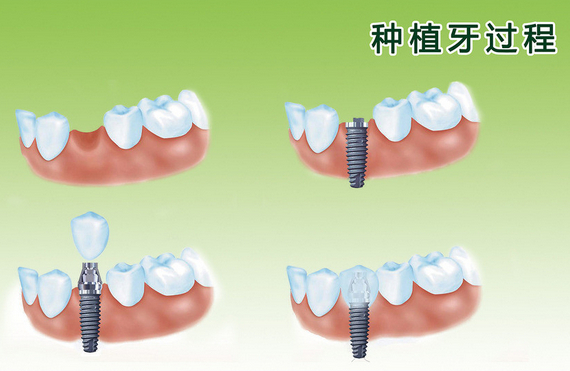 北京口腔医院种植全口牙有危险吗