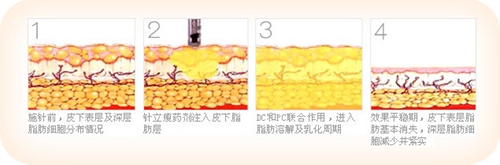 注射瘦身效果好吗