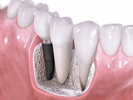 种植牙手术前后应该注意什么呢