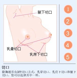假体隆胸手术方法