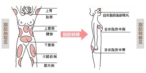 自体脂肪移植术