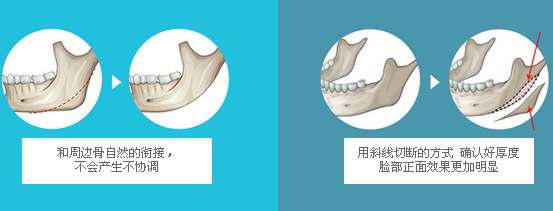 韩国ID整形下颌角手术