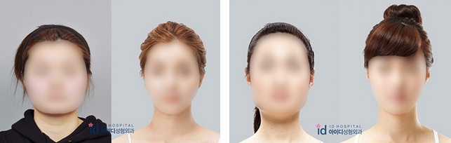 韩国ID整形医院手术前后对比图