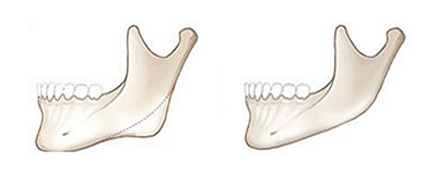 下颌角截骨
