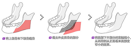 皮质截骨术