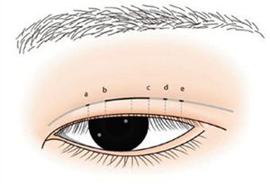 双眼皮是怎样切开的