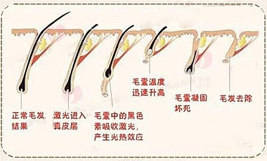 激光脱毛原理
