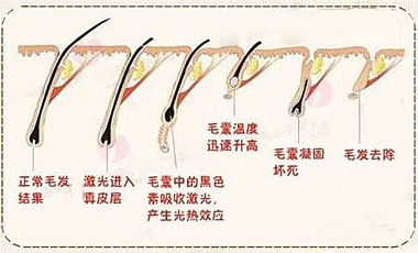 激光脱毛原理