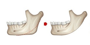 下颌角整形