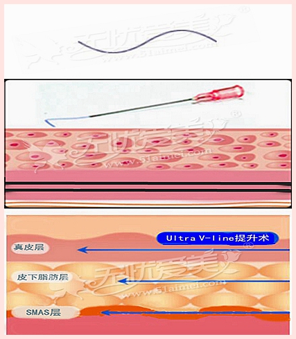 Ultra V-line提升术