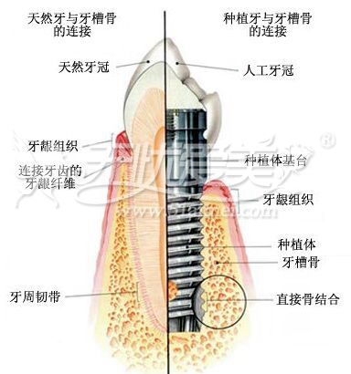 种植牙适应症有哪些?能保持多久?