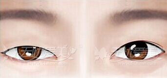 眼睛类型不同双眼皮手术各不同——实用型美眼攻略