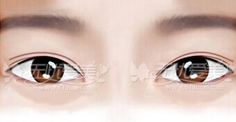 眼睛类型不同双眼皮手术各不同——实用型美眼攻略
