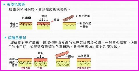 女神YES！女婶NO！连冰冰都大爱的镭射净肤