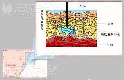 全面解析溶脂针 有了它真的想瘦哪里瘦哪里吗