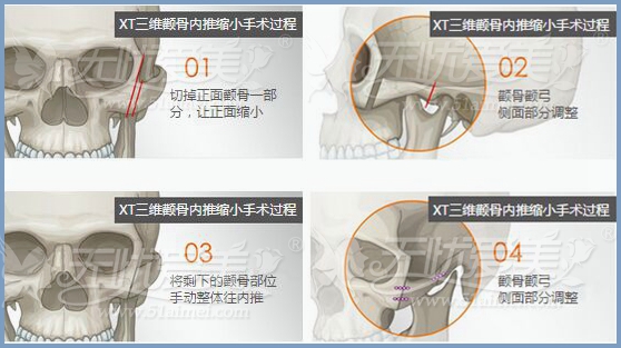 颧骨突出颧骨高怎么办？拯救方法在这里