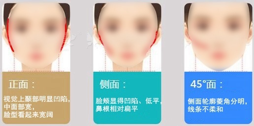 颧骨突出颧骨高怎么办?拯救方法在这里
