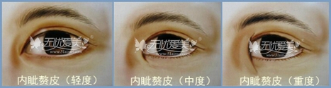 还在担心开眼角后留疤?对付疤痕我有绝招