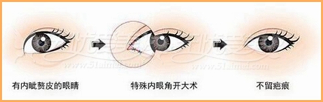 还在担心开眼角后留疤?对付疤痕我有绝招