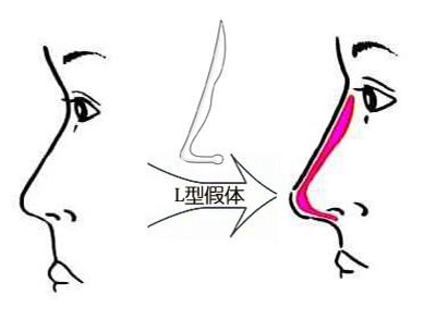 做完隆鼻就后悔，能马上取出胿胶吗