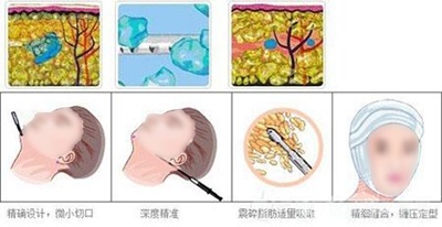 面部吸脂多久可以恢复