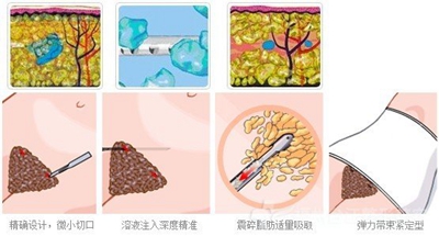 腹部溶脂有危险么?