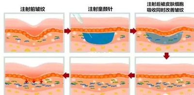 童颜针和脂肪填充哪个副作用小?