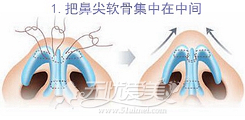 韩国自体软骨隆鼻