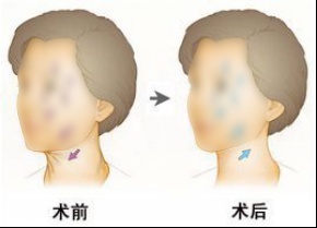 除皱针真的能除皱么