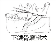 下颌角磨削术