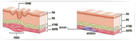 注射瘦脸针除鱼尾纹
