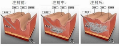 自体脂肪填充除鱼尾纹