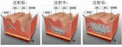 自体脂肪填充除鱼尾纹