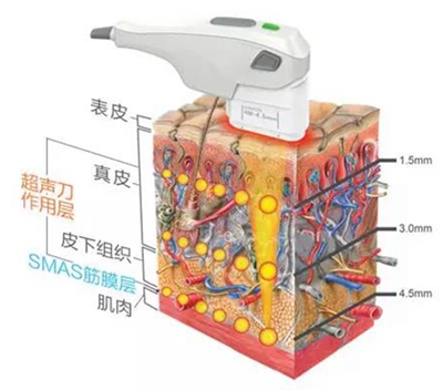 韩国超声刀