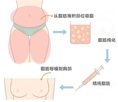 韩国自体脂肪隆胸哪家医院好？多少钱？