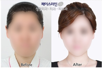 韩国face-line整形医院两鄂手术案例