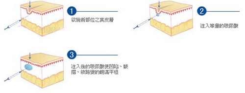 玻尿酸注射