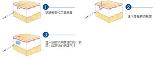 玻尿酸注射