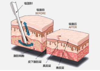 吸脂减肥手术