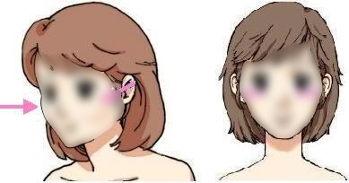 韩国颧骨整形手术 让脸庞轻松小一圈