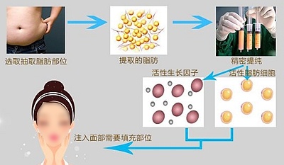 面部脂肪填充