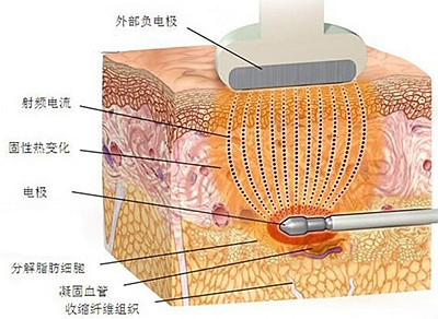 射频溶脂