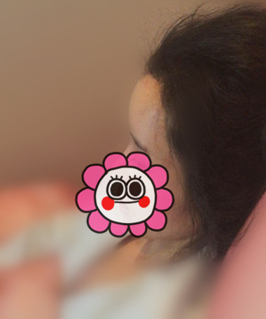 自体脂肪填充额头 快成寿星老还嫌不饱满