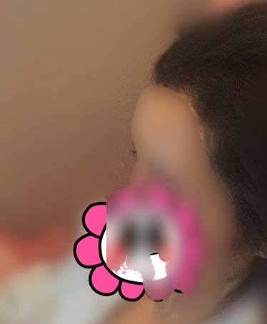 自体脂肪填充额头