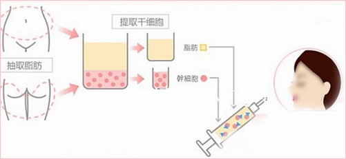 自体脂肪注射填充