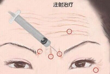 自体脂肪注射填充