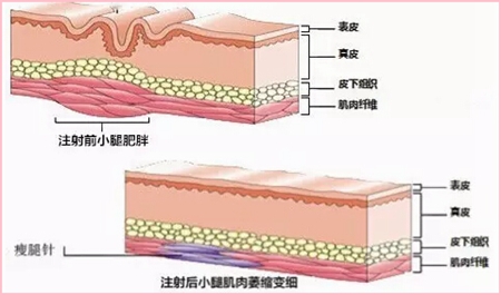 瘦腿注射原理